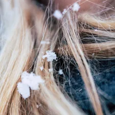 a close up of a woman with snow flakes on her hair related to The Unwelcome Hitchhiker: Dealing with Bed Bugs in Hair