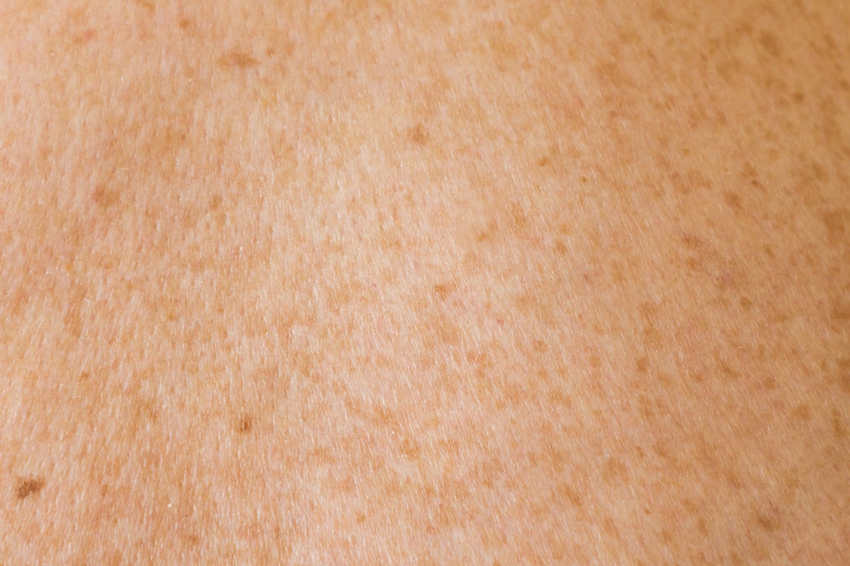 Human skin texture with freckles related to The Hidden Dangers of Tanning Bed Rash