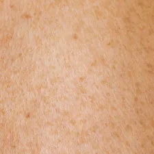 Human skin texture with freckles related to The Hidden Dangers of Tanning Bed Rash